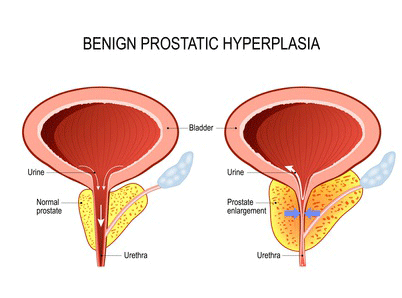 BPH Enlarged Prostate 